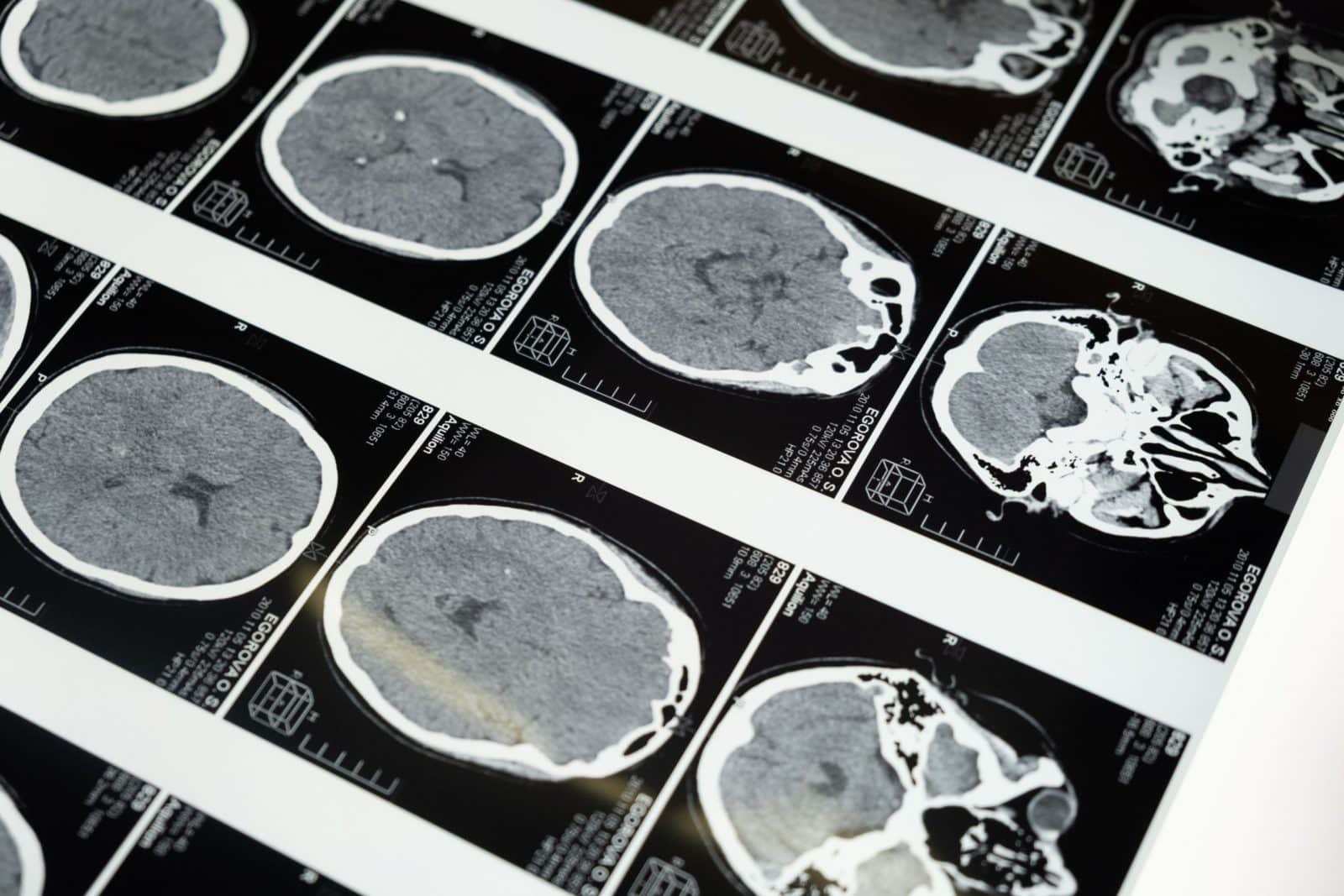 Brain scan from TBI given to TBI lawyer